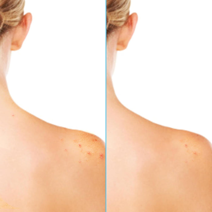 Differin Body Acne Treatment – Practical Birthday Gift for Active Friends Who Work Out, 6 oz Mist