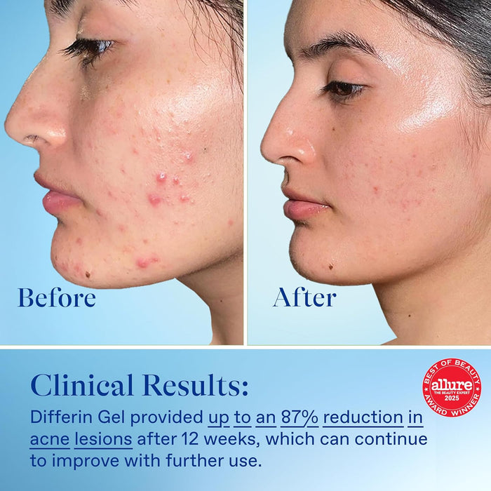 clinically validated: up to 87% acne reduction in 12 weeks (cunliffe et al 1998)