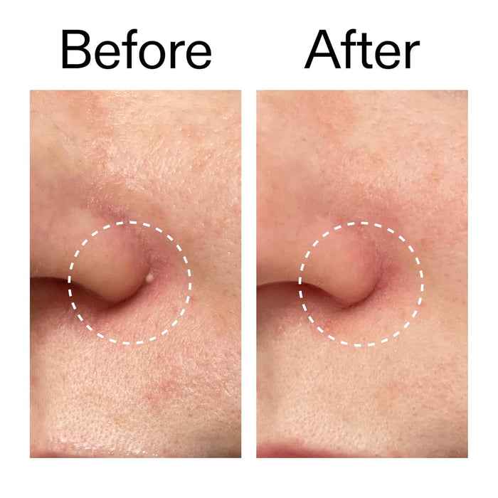The INKEY List Acne Pimple Patches Mindful Self-Care Addition for Bedroom Wind-Down Routine